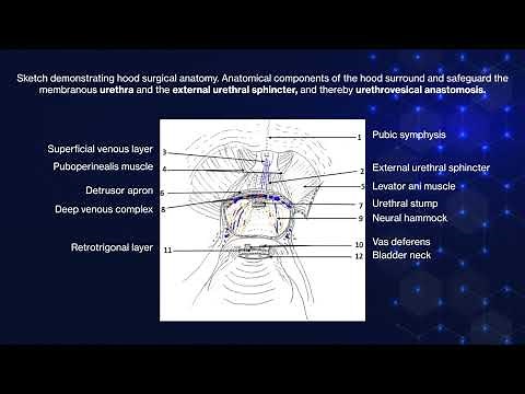Hood Technique for Robotic Radical Prostatectomy