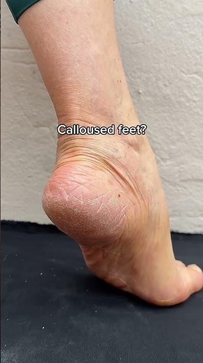 CRUSTY FEET PROBLEMS?? NO WORRIES!
