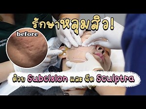 รักษาหลุมสิวด้วยการทำ Subcision + ฉีด Sculptra | This is Pear