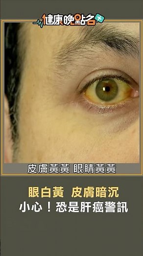 眼白黃 皮膚暗沉 小心！恐是肝癌警訊