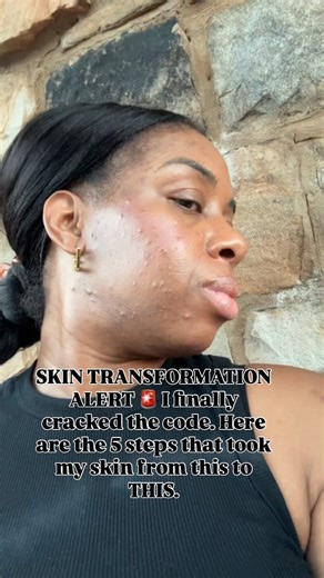Healthy skin matters!!!!! 😘💕 I’m sharing the exact 5 steps I used to transform my skin NO Botox and no fillers. Comment the word “SKIN” in the comments for the direct links and details! 👇🏾 You deserve clear skin 2026 sister! Tag another sister Here’s why you NEED our tumeric soap 👇🏾 It has ALL of these ingredients * Turmeric for a natural glow, preventing clogged pores, and calming inflamed skin. * Honey to moisturize, exfoliate, and fight acne while helping to lighten scars. * Lemon to fa