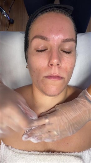 Double the power, double the results! When it comes to stubborn hyperpigmentation and lingering acne scars, one treatment isn’t always enough. That’s why we pair DMK Quick Peel with BioRePeel for next-level skin revision: 🔥 Quick Peel – increases circulation, oxygenates the skin, and softens scar tissue to prep your skin for deeper revision. 🧬 BioRePeel – a no-downtime TCA peel that targets pigmentation, stimulates collagen, and helps remodel skin texture. Together, they speed up cell turnover