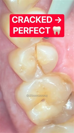 Cracked Tooth → Immediate Implant → Perfect Crown 🦷
