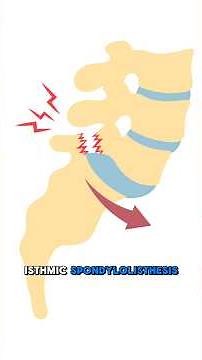 Not all spondylolisthesis is the same.