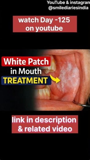 Day-126 White Patch in Mouth? Treatment from Home Remedies to Surgery‪@Smilediariesindia‬