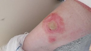'Deodorant Challenge' can cause permanent burn scarring