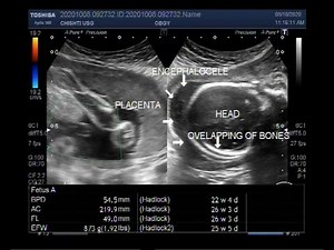 Ultrasound Video showing Pregnancy of 26 weeks with fetal demise and positive Spalding sign.