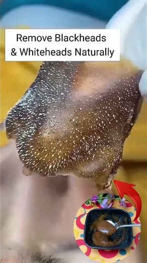 Remove Blackheads Permanently At Home Blackheads Removal Easy Tips ✨ Clear Glass Skin