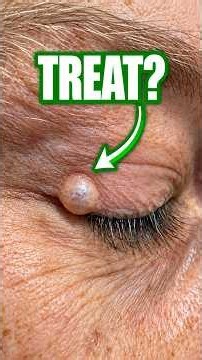 Eyelid Cancer or Eyelid Cyst?