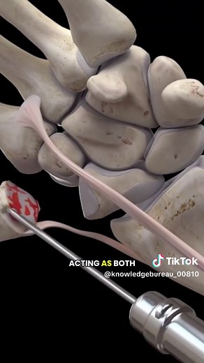 How A Tendon Can Replace Trapezium Bone In Thumb Arthritis? (3D Animation) #trpeziumbone #thumbarthritis #tendon #wristsurgery #arthritissurgery #arthritistreatment #medical3danimation #3dmedicalanimation