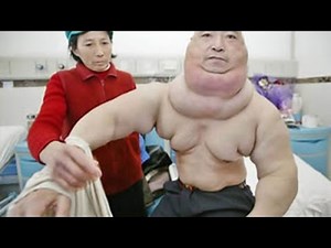 5 INCREDIBLE HUMAN MALFORMATIONS!