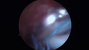 Massive Rotator Cuff Tear Repair (3 tendons): Double Layer, Double Row, Plus Subacromial Spacer