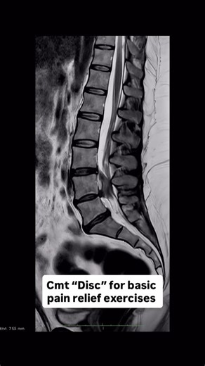 DISC BULGE & DISC PROTRUSION – EXPLAINED 🧠🦴 An MRI-based animation showing how a disc bulge develops and can progress into disc protrusion, placing pressure on spinal nerves and causing: • Back or neck pain • Radiating arm or leg pain • Tingling, numbness, or weakness ✅ Early diagnosis ✅ Correct physiotherapy ✅ Spinal stabilization & posture correction can help prevent worsening and avoid surgery in many cases. 🎯 Treat the cause, not just the pain. — Dr. NS Bal Governing Physiotherapist Chand