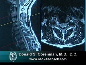 Understanding an MRI of a Cervical Nerve Compression | Colorado