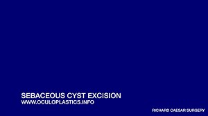 Excision of Sebaceous Cyst