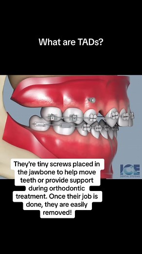 Dylan's TADs Experience: A Guide to Braces Off Journey