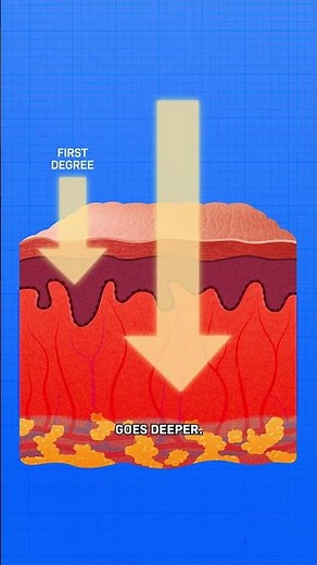 How Do Sunburns Work?