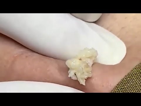 60 Min ⚕️ Satisfying Blackhead Removal & Pimple Popping – Zit Happens #010