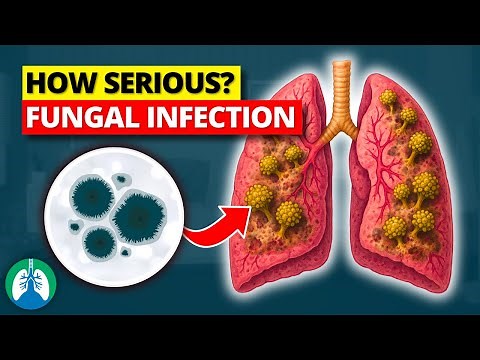 How Serious is a Fungal Infection in the Lungs?