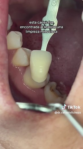 Understanding Caries Dental: Causes and Treatment Explained