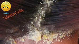 3.4K views · 26 reactions | So Much Worms On Head Scalp Psoriasis Treatment And Worm Hole Removing # 201 | Fun988 | Facebook