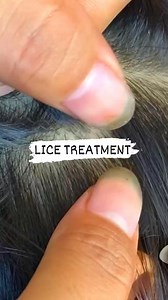 189K views · 846 reactions | Treatment Kuto,  #kuto #lice #piojos | srieyontha.shop | Facebook