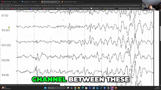 When focal points point to each other, what's the common channel? By identifying the common electrode, you'll discover the isolated EEG area needing further assessment. Key insight for EEG analysis. #EEGAnalysis #FocalPoint #Electrode #Neuroscience #BrainActivity | SleepA2Z