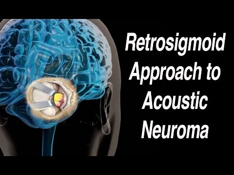 Retrosigmoid (or Suboccipital) Approach to Acoustic Neuroma Surgical Removal