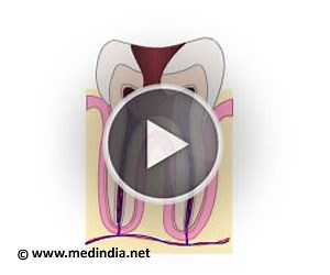 Health Animation - Root Canal Treatment