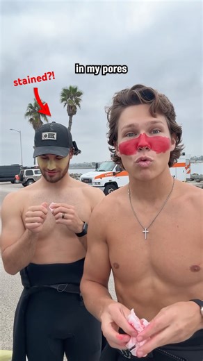 The Zinc STAINED His SKIN?! 😭