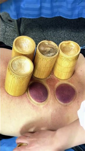 Bamboo cupping technique used for traditional therapy treatment