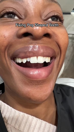 Restoring Peg Shaped Laterals with Composite Veneers