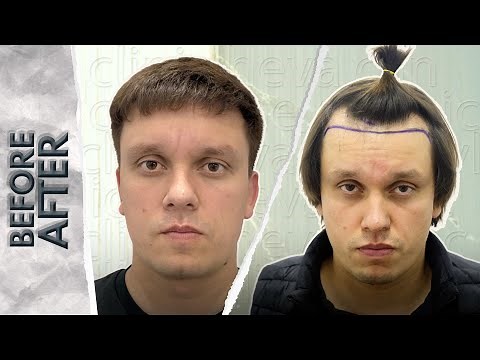 3000 Grafts Unshaven FUE Hair Transplant – 8-Month No-Shave Transformation | Heva Clinic Turkey