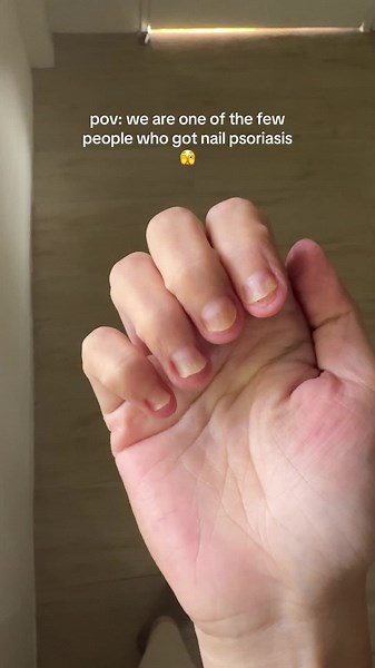 Overcoming Nail Psoriasis: Treatment and Care