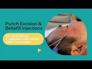 Punch Excision & Bellafill Injections for Acne Scars COMBINATION ASIAN SKIN Treatment |Dr.Jason Emer