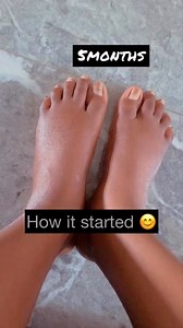 Edema is your body holding more water than usual when you are pregnant. It is also a sign of preeclampsia. If you notice your feet are swollen, please see your doctor. You can manage edema by the following - ⭐ Reduce sodium (salt) intake. ⭐Increase potassium intake. Your prenatal supplement contains potassium. Other sources of potassium are bananas,beans, spinach, carrot, beetroot etc ⭐ Avoid caffeine intake. ⭐ Drink more water. ⭐ Elevate your feet when you are sitting and rest well ⭐ Wear loose