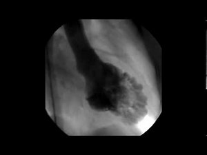 Left ventricular non compaction 3/3