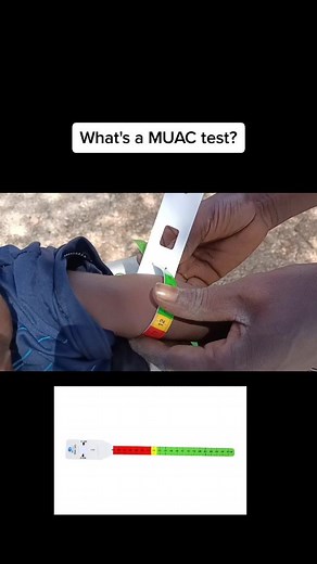 Understanding MUAC Test for Child Nutrition