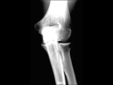 Normal Elbow on X ray