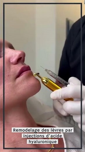 Remodelage des lèvres par injections d’acide hyaluronique avec le Dr Essayagh.