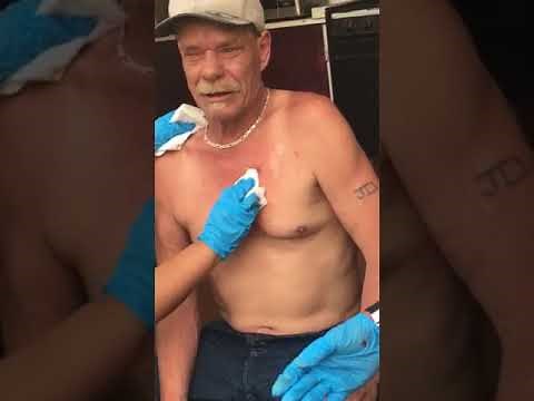 biggest backyard cyst pop