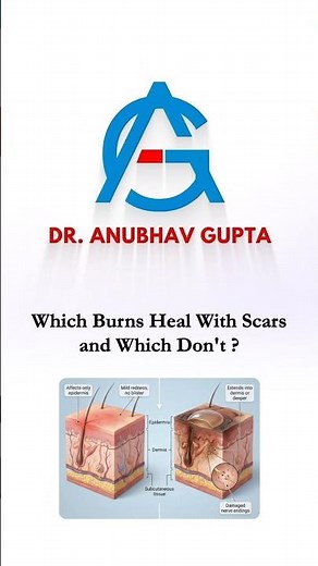 Burn Scars Explained | Which Burns Leave Scars & Which Heal Without Scars? #handsurgery