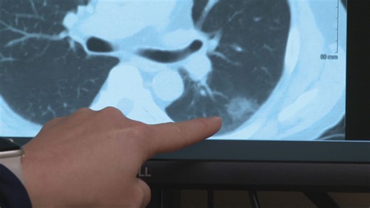 Doctors utilize AI for life-saving early cancer detection Ohio Christ Hospital