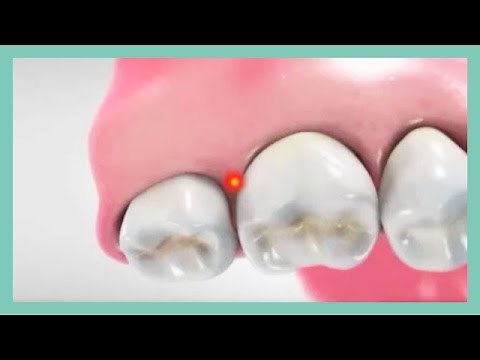 The Wand Intraligamentary Injection Tutorial