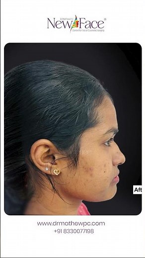 Jaw Surgery Before and After | Corrective Jaw & Orthognathic Surgery Transformation #drmathewpc