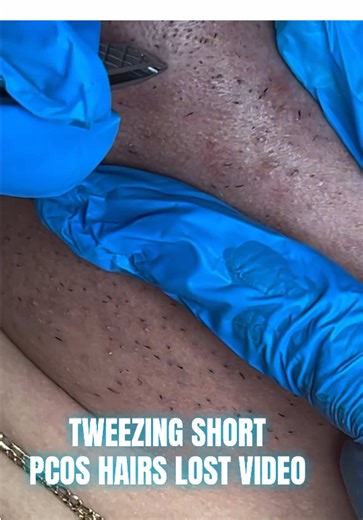 Found this TB short video clip of me tweezing a few of my PCOS model. It’s super important to make sure you exfoliate and stay hydrated when you have hirsutism. Lack of hydration can make your skin super dry and make it hard to tweeze stubborn hairs. Tweezers are the men’s series from Revlon #fyp #extractions #pcos #foryoupage #waxtok