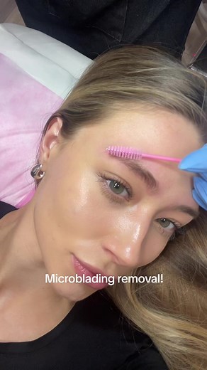Eyebrow Microblading Removal Progress Update