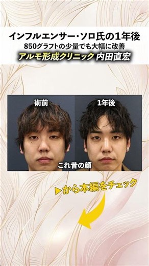 [1 Year Close-Up] Influencer Solo's Hair Transplant: A Complete Look One Year Later!