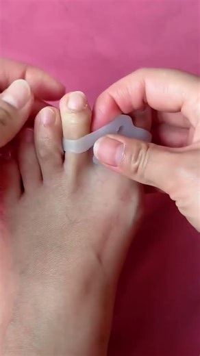 #Footcare #Bunion #OverlappingToes