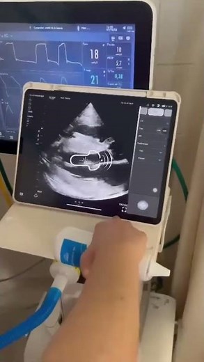 Portable Handheld Wireless Cardiac Ultrasound #portableultrasound